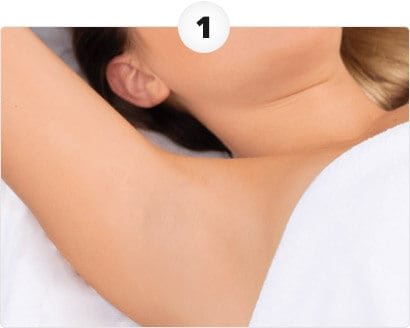 How miraDry works step 1