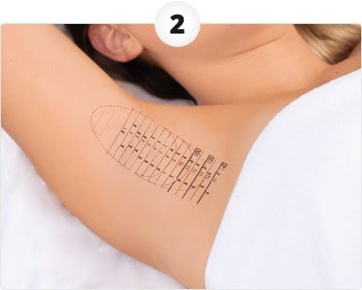 How miraDry works step 2