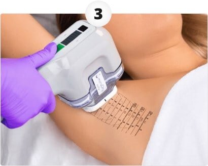 How miraDry works step 3