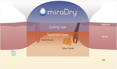 miraDry process 3